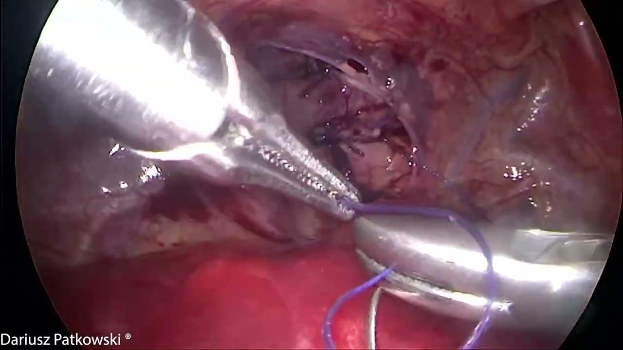 Esophageal atresia type C thoracoscopic repair by Prof. Dariusz Patkowski