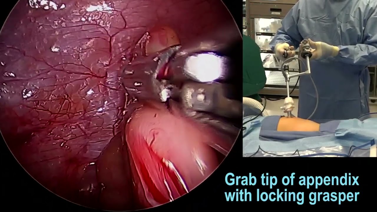 Single Incision Laparoscopic Appendectomy (SILS) by Dr. Nelson Rosen